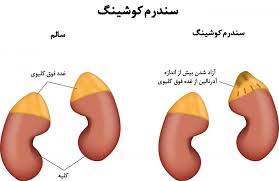 تومور غده فوق کلیوی