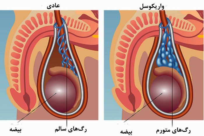 واریکوسل