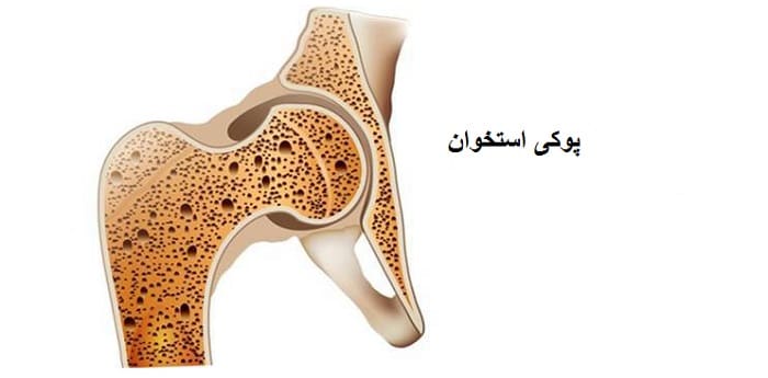 پوکی استخوان